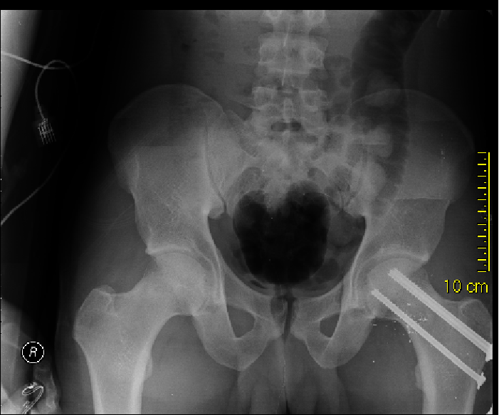 Femoral Neck Fractures Trauma Orthobullets